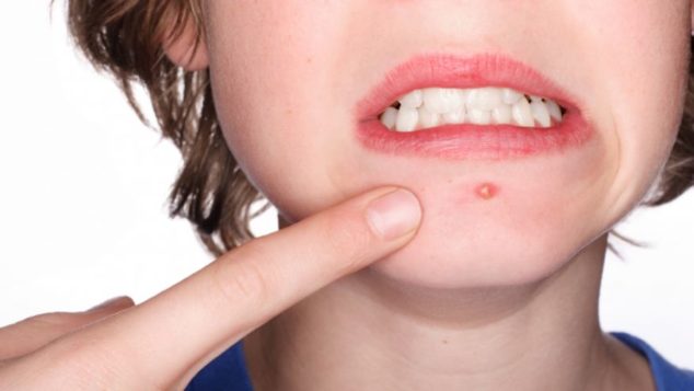 ACNE_USE